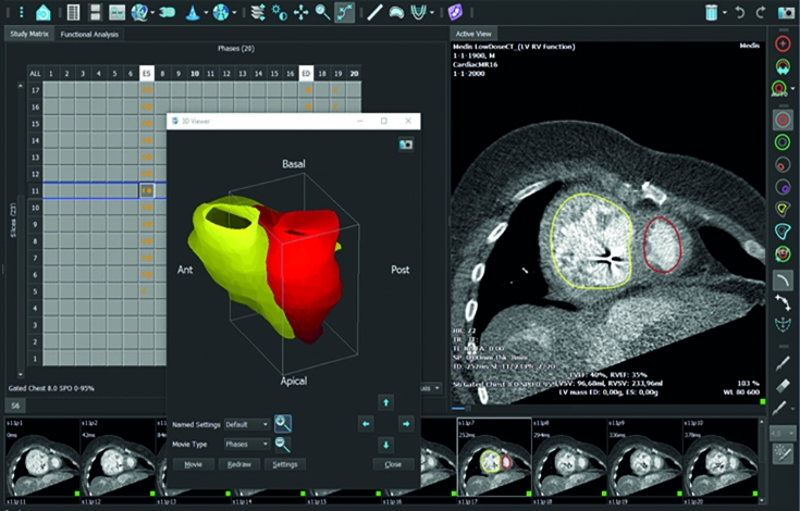 Olea Medical-Cardiology, Kryptonite solutions