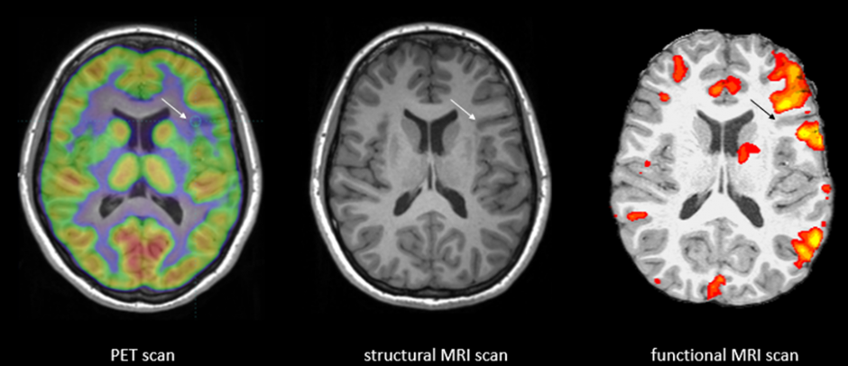 Difference between MRI and fMRI, Kryptonite solutions