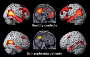 schizophrenia patient