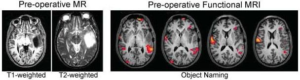 pre-operative fMRI