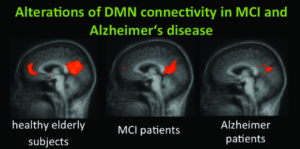 Alzheimer patients brain