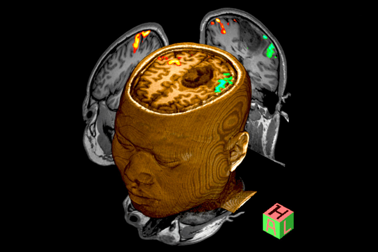 Unveiling the Power of fMRI: Neurological Disorders and Trauma Patients, Kryptonite Solution