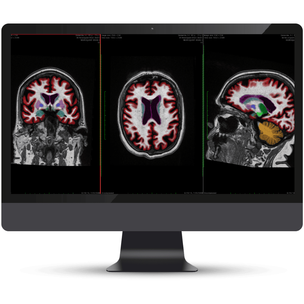 Olea Medical-Cardiology, Kryptonite solutions
