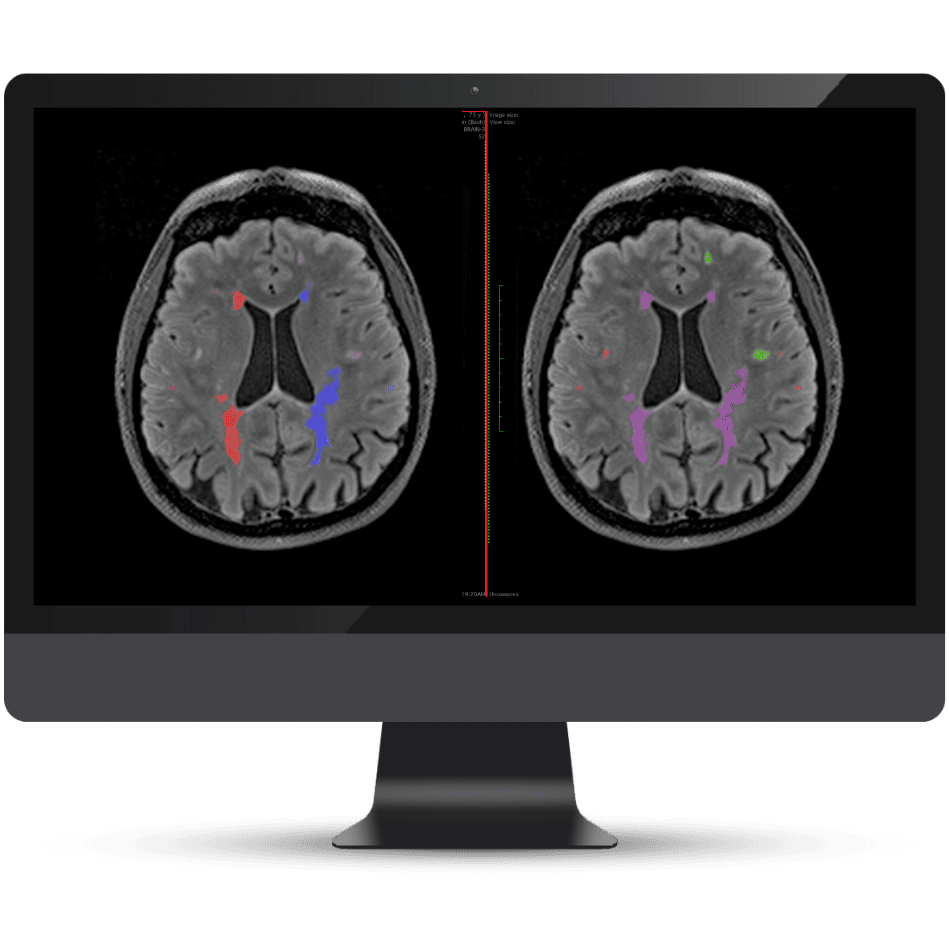 Olea Medical-Cardiology, Kryptonite solutions